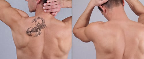 NYC laser tattoo removal