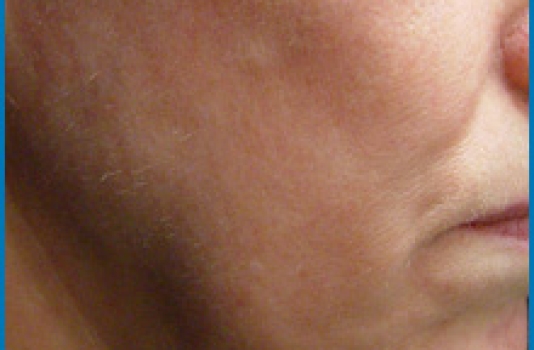 Laser Skin Tightening Before And After