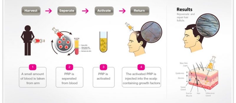 Platelet-Rich-Plasma-PRP-Therapy-for-Hair-Restoration