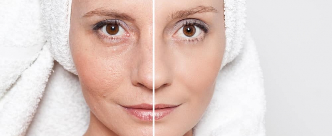 Surgical Vs Non Surgical Skin Tightening Procedures